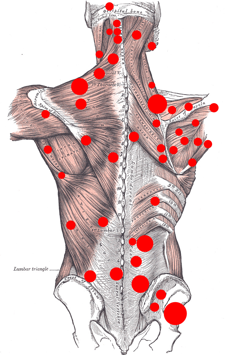 What is myofascial pain syndrome? | Health Care Victoria